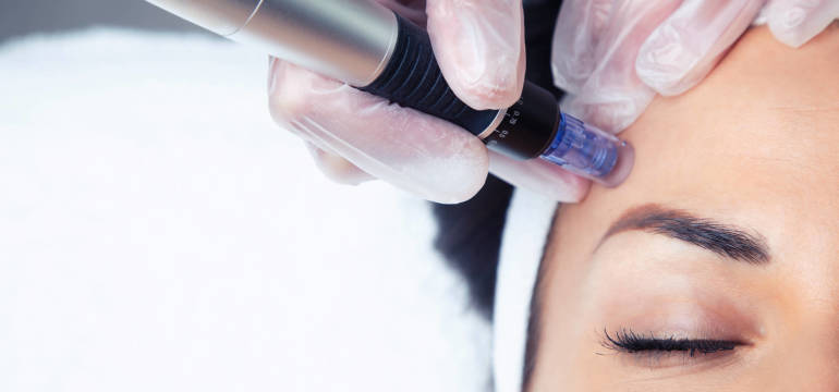 Mezoterapia mikroigłowa z wykorzystaniem technologii Dermapen™ w ofercie Ośrodka Medycyny Estetycznej „Dwór Kuźniczki”