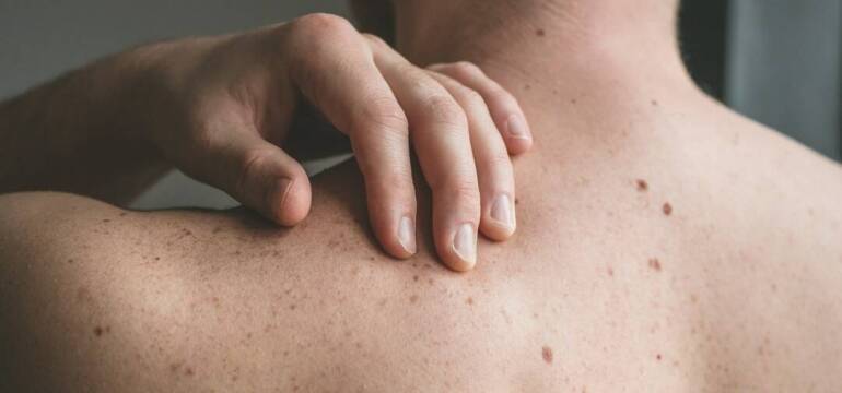  Diagnostyka znamion na skórze - Katarzyna Niksa Specjalistyczny gabinet dermatologiczny