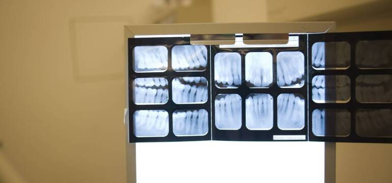 Znaczenie i sposób przeprowadzenia badania RTG zębów – R-Dent