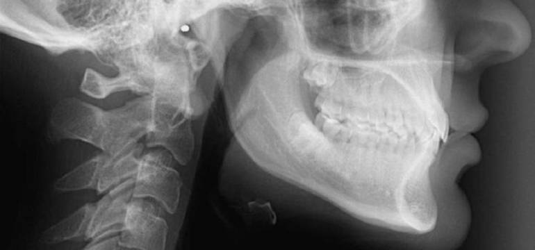 Zdjęcie telerentgenogramem (cefalometryczne) – czym jest?
