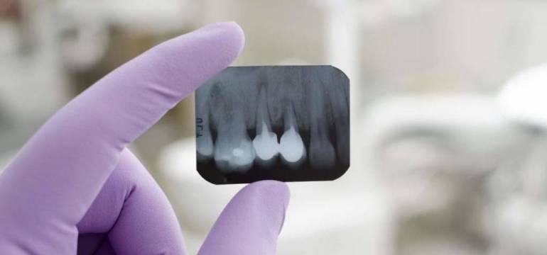 Zdjęcia punktowe zęba