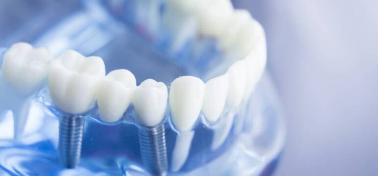 Implanty zębowe – nowoczesne rozwiązania w Masterdent