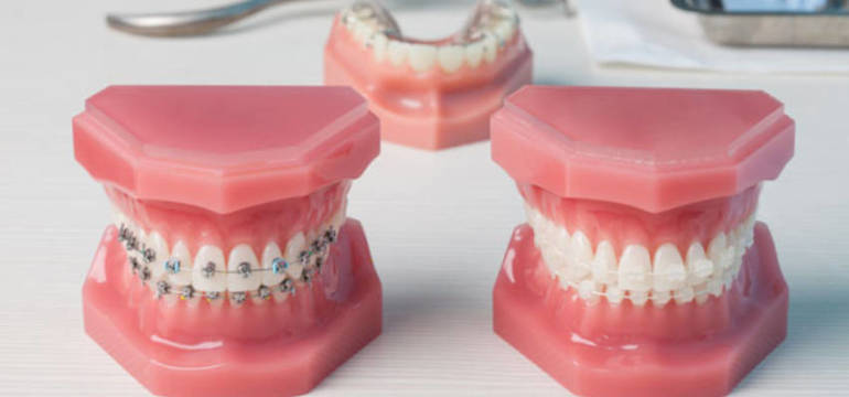 Какие брекеты выбрать для ребенка?