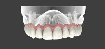Technologia 3D w stomatologii – zastosowania i procesy