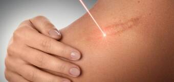Laserowe zabiegi na skórę - Klinika Venus-Estetic