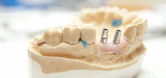 Wszczepianie implantów zębowych w klinice ELLMED 