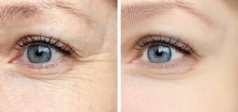 Co warto wiedzieć o toksynie botulinowej? Zabieg w salonie Bonjour Beauté!