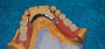 Naprawa protez szkieletowych w Pracowni Techniki Dentystycznej