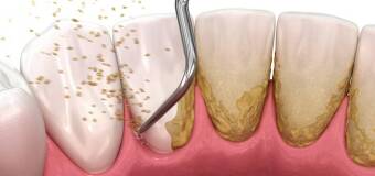 Skaling: Co to jest i dlaczego jest tak ważne dla zdrowia jamy ustnej?