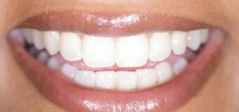 Bonding zębów – poprawa estetyki uśmiechu