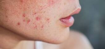 Leczenie trądzika różowatego w Olsztynie