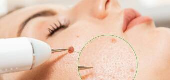 Obserwacja zmian skórnych - Piotr Smoczyk Gabinet Chirurgiczny