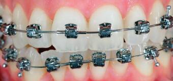 Pierwsza wizyta u ortodonty – co warto wiedzieć?