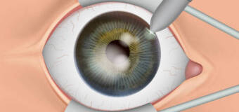 Przygotowanie do zabiegu usunięcia zaćmy i to, co decyduje o kwalifikacji