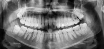 Jak dentysta ocenia, czy ból zęba wymaga leczenia zachowawczego czy pilnej interwencji
